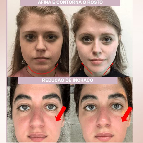 V-Mask - Contorno Facial e Redutor de Papada - Imagem 7