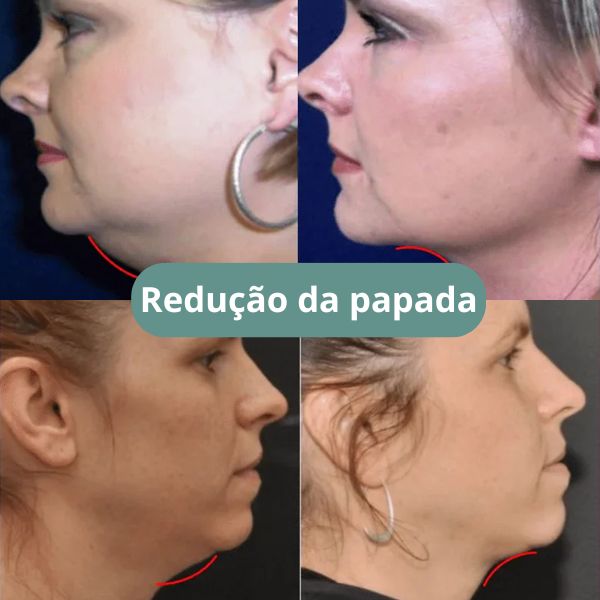 V-Mask - Contorno Facial e Redutor de Papada - Imagem 6